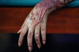 Woman suffers burns in acid attack