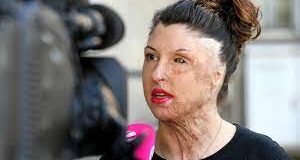 Widow suffers burns in acid attack